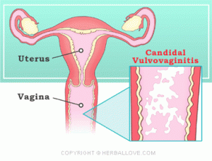 infeccion vaginal