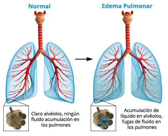 edema pulmonar factores