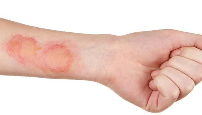 que hacer ante una quemadura